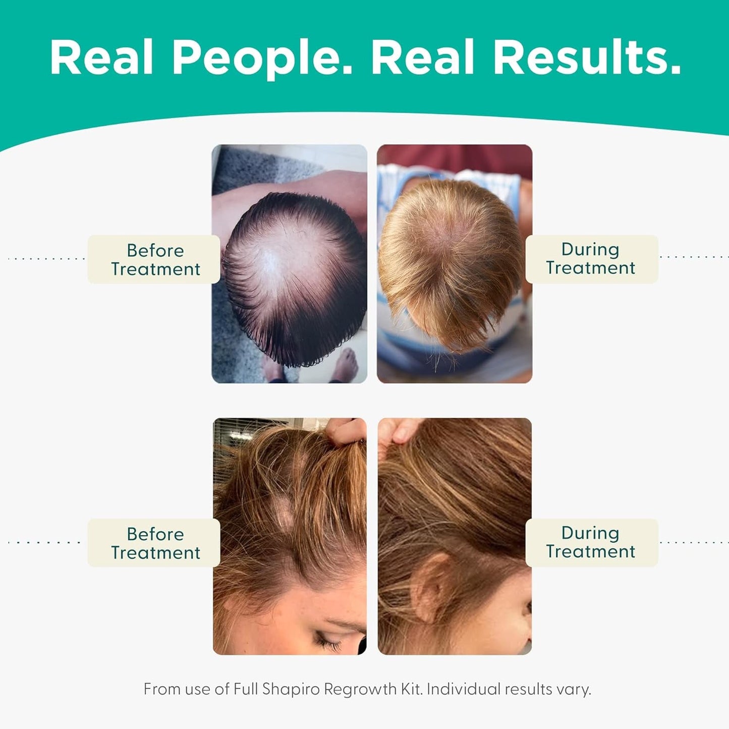 Vegan Hair Loss Shampoo for Thinning Hair | Experience Healthier, Fuller and Thicker Looking Hair (1 Month Supply)